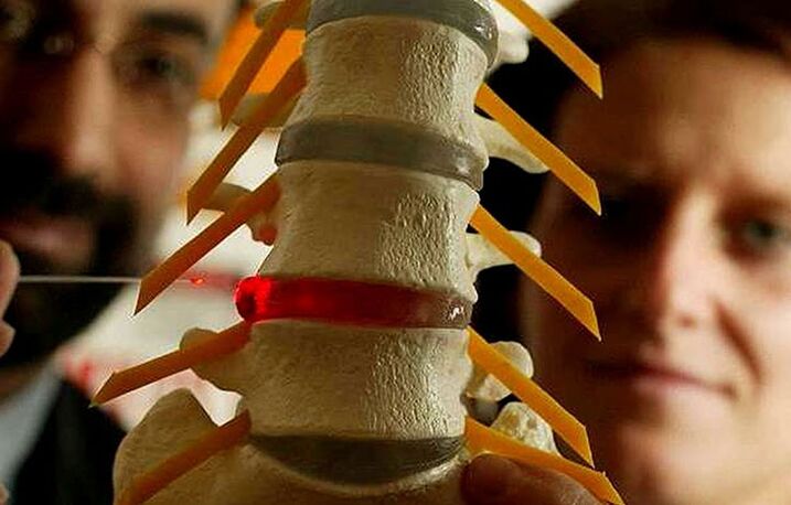 Änderungen in der Integrität der Intervertebral -Aufzeichnungen