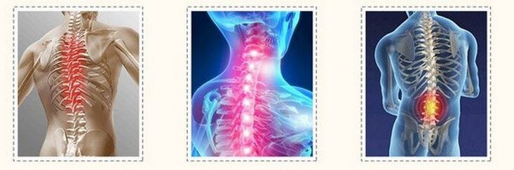 Osteochondrose der verschiedenen Wirbelsäule