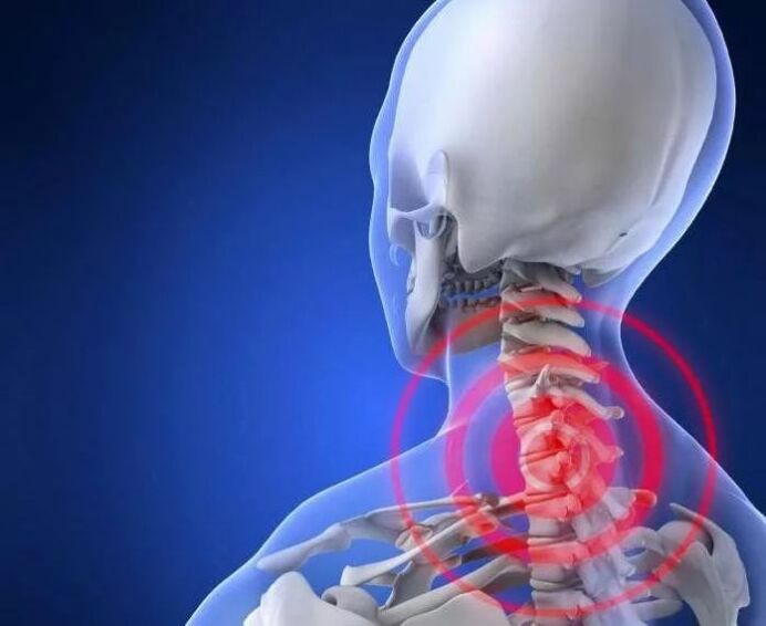Was ist Osteochondrose
