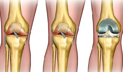 Der Grad der Entwicklung der Arthrose des Kniegelenks