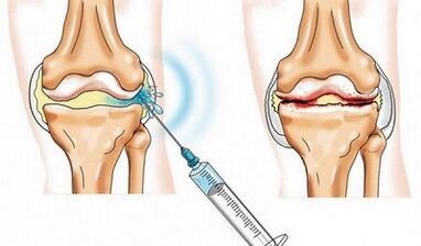 Die Blockierung des Kniegelenks für Arthrose