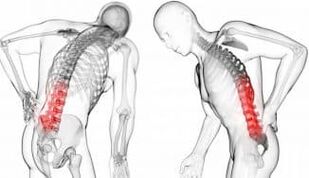 Zwischenvertebralhernie - Komplikation mit Osteochondose