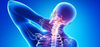 Ursachen für zervikale Osteochondose