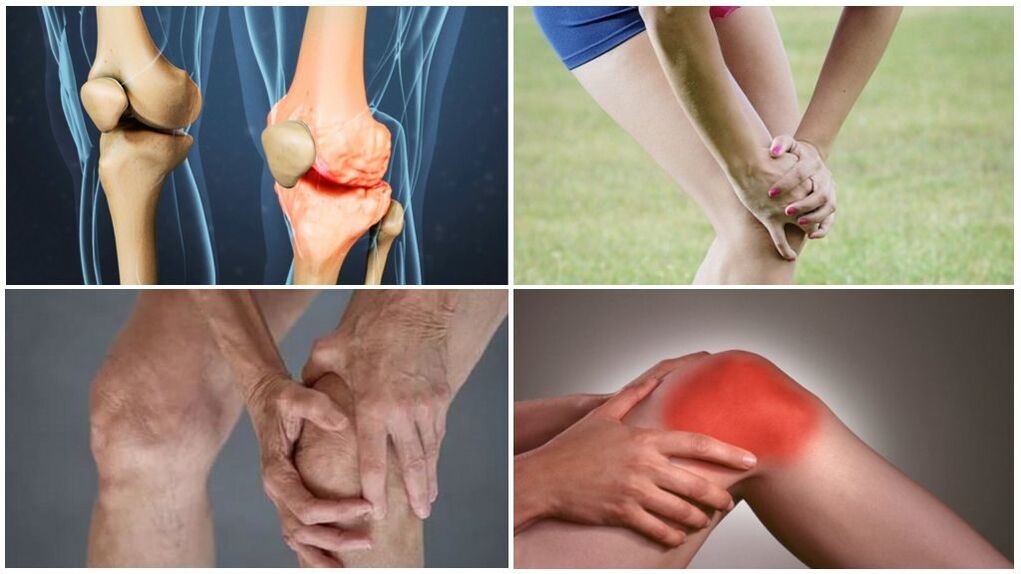 Osteoarthritis -Phase