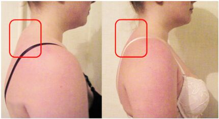Bildung von Muskelrollen mit zervikaler Osteochondose