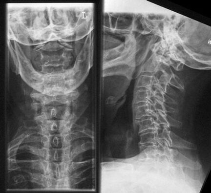 Cervical X -Ray - Diagnose der Osteochondose -Methode