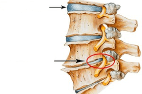 Normale und beschädigte Wirbelsäule mit zervikaler Osteochondose