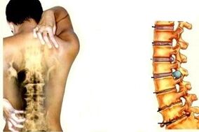 Rückenschmerzen in verschiedenen Stadien der Entwicklung von zervikaler Osteochondose
