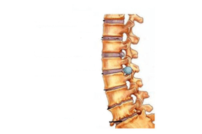 Schädigung der Wirbelsäule mit zervikaler Osteochondose