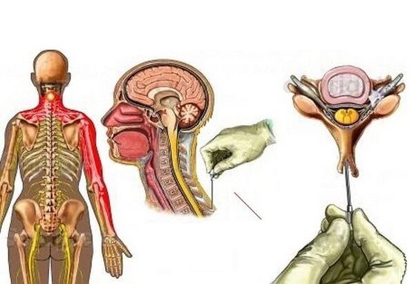 Behandlung der zervikalen Osteochondrose mit Akupunktur