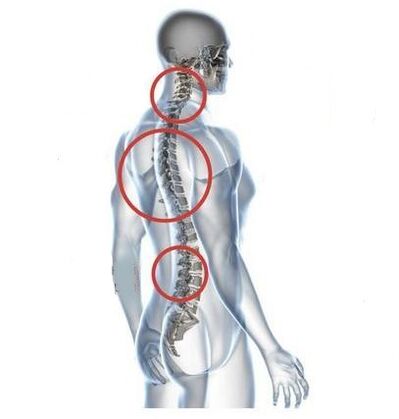 Stellen der spinalen Osteochondrose