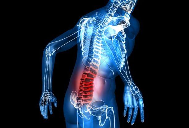 Was ist lumbale Osteochondrose