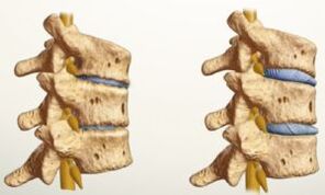 Wie sieht Osteochondrose aus