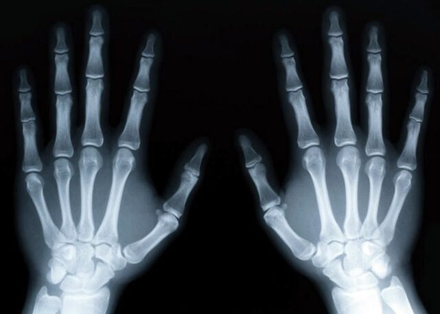 Gicht führt zur Entwicklung einer Gichtarthritis, die mithilfe von Röntgenstrahlen diagnostiziert werden kann