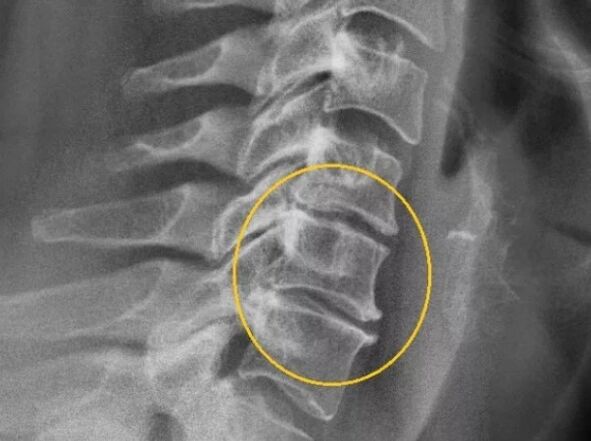 Osteochondrose der Halswirbelsäule im Röntgenbild